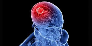 3 evre beyin tümörü